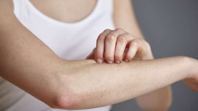 Pessoa coçando o braço: sintoma mais comum da urticária é a coceira 