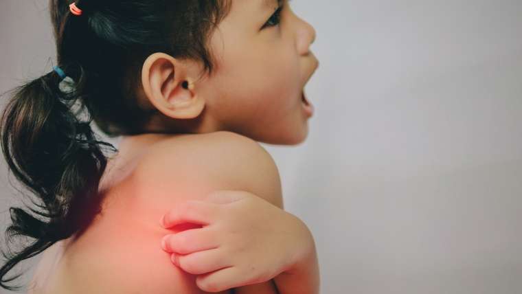 Criança se coçando: urticária é uma irritação cutânea, caracterizada por lesões avermelhadas e levemente inchadas