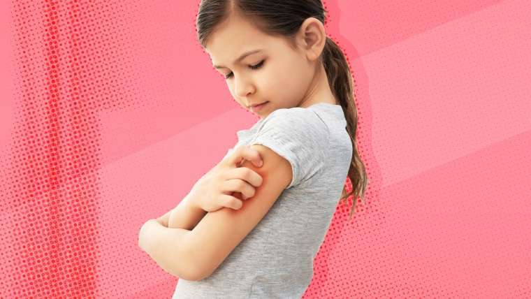Criança com coceira no braço: as lesões são mais frequentes nas pregas dos braços, pescoço e pernas 
